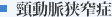 頸動脈狭窄症